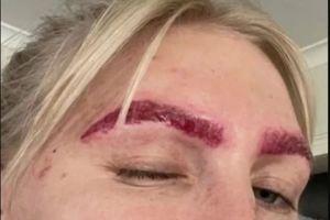 Influenciadora tenta remover micropigmentação com procedimento de laser e resultado choca internautas